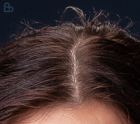 Hair loss and thinning scalp treated by dermatologists at Atmos Derm Skin Clinic Kozhikode